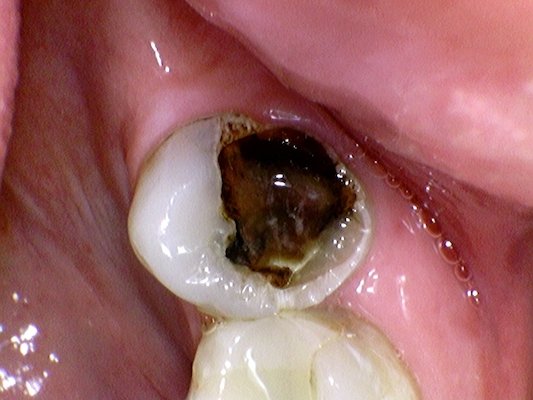 Cavity broken rotted tooth fix before