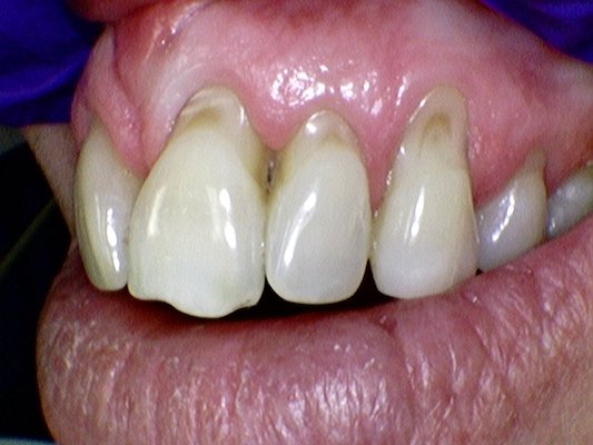 Receding gum sensitive tooth root exposure before