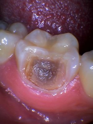 huge cavity broken rotted tooth fix before