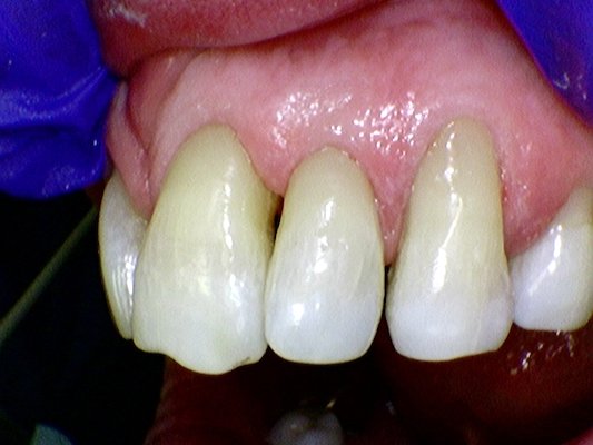 Receding gum sensitive tooth root exposure after