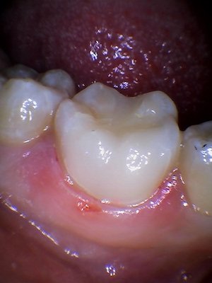 huge cavity broken rotted tooth fix after