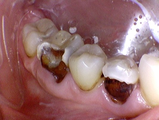 multiple cavities broken rotted teeth fix before