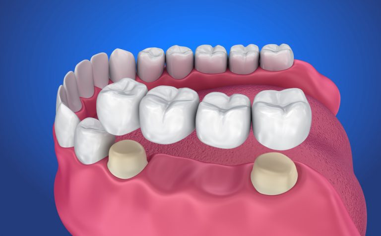 dental bridge benefits